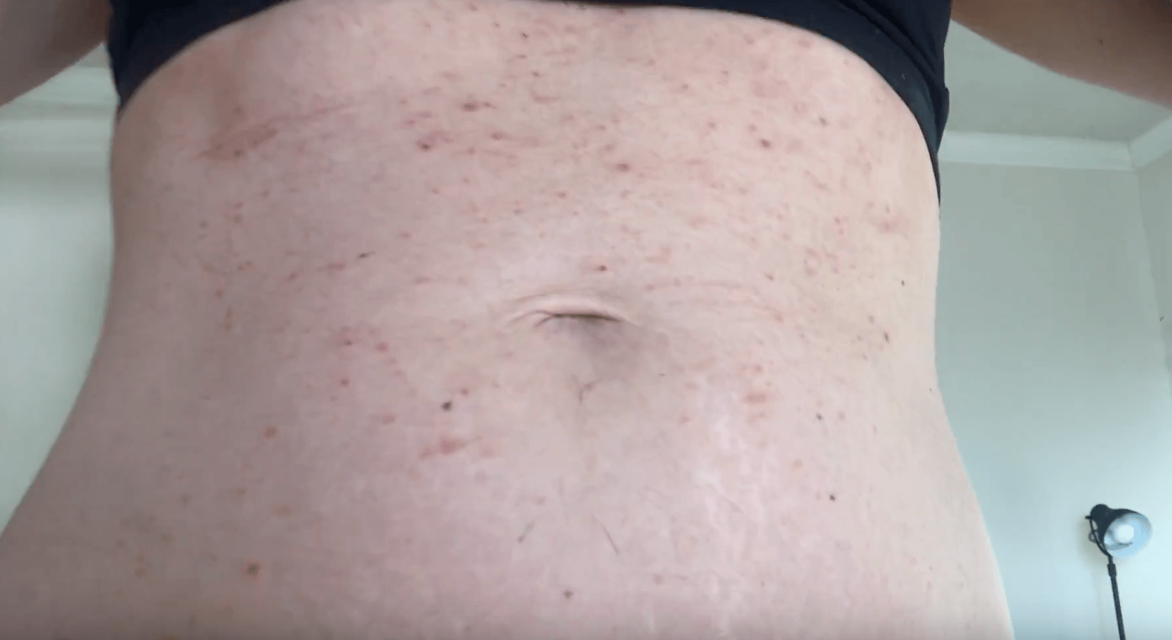 PUPPP Rash: What to Know About This Pregnancy Rash